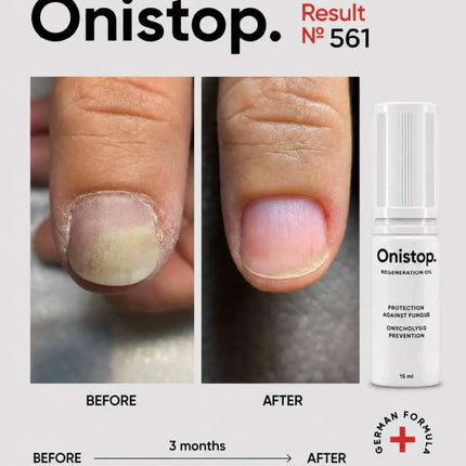 Αναγεννητικό λάδι κατά της ονυχόλυσης - OniStop 15ml NAILSOFTHEDAY