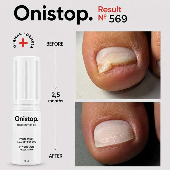 Regenerating oil against onycholysis - OniStop 15ml NAILSOFTHEDAY