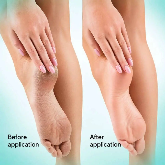 Κερατολυτικό τζελ για τοπική χρήση Soft Blade Shelly 100 ml